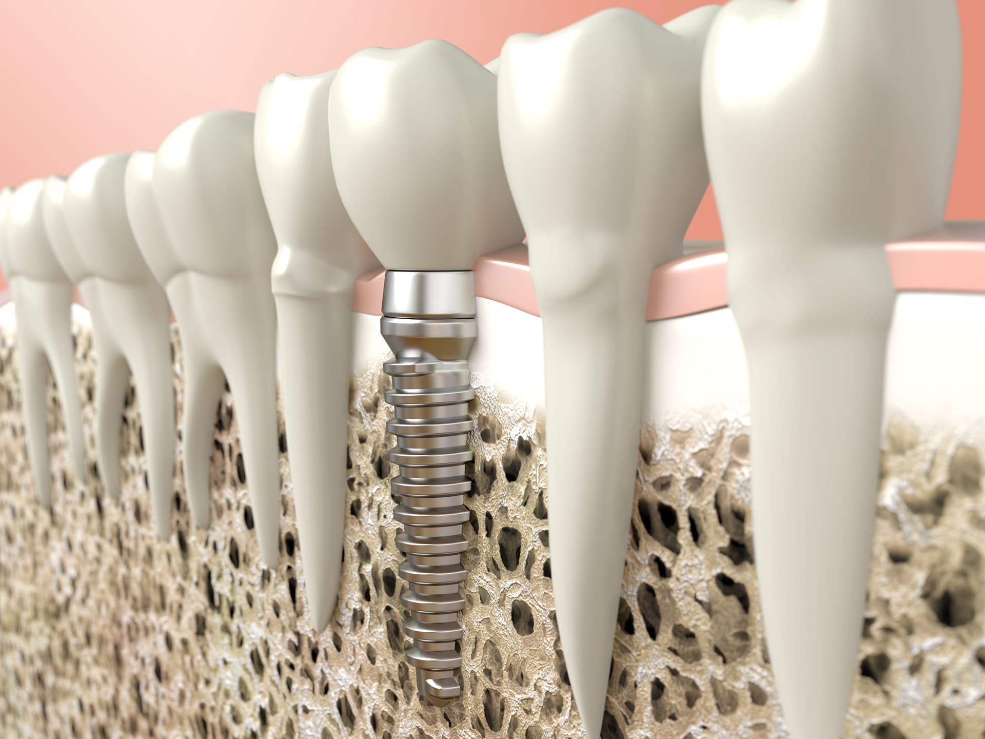 Contacte con nuestros especialistas en implantes dentales en Foz